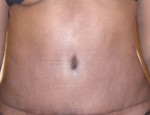 Tummy Tuck (Abdominoplasty)