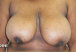 Breast Reduction (Reduction Mammaplasty)