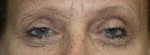 Eyelid Surgery (Blepharoplasty)