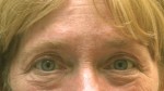 Eyelid Surgery (Blepharoplasty)