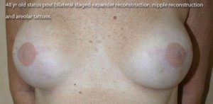 Breast Reconstruction after Mastectomy
