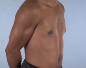 Gynecomastia (Male Breast Reduction Surgery)