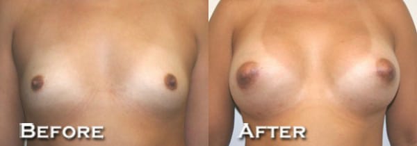 Breast Augmentation Before & After - Dr. Thomassen