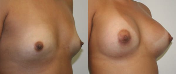 Breast Augmentation Before & After - Dr. Thomassen