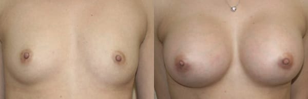 Breast Augmentation Before & After - Dr. Thomassen