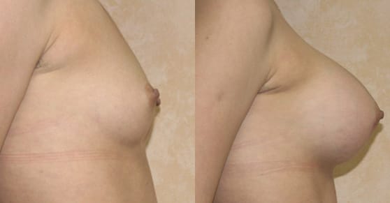 Breast Augmentation Before & After - Dr. Thomassen