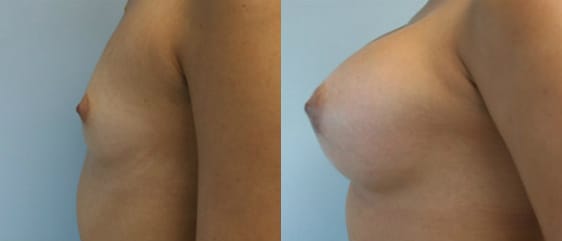 Breast Augmentation Before & After - Dr. Thomassen