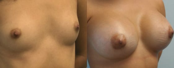 Breast Augmentation Before & After - Dr. Thomassen