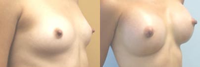 Breast Augmentation Before & After - Dr. Thomassen