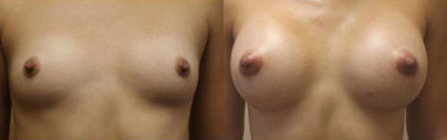 Breast Augmentation Before & After - Dr. Thomassen