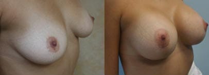 Breast Augmentation Before & After - Dr. Thomassen
