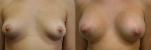 Breast Augmentation Before & After - Dr. Thomassen