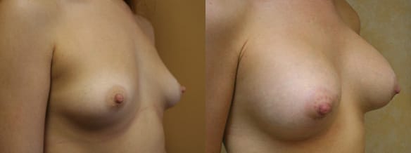 Breast Augmentation Before & After - Dr. Thomassen