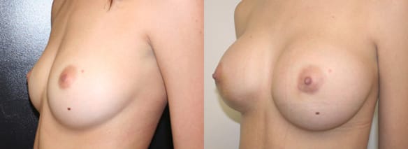 Breast Augmentation Before & After - Dr. Thomassen