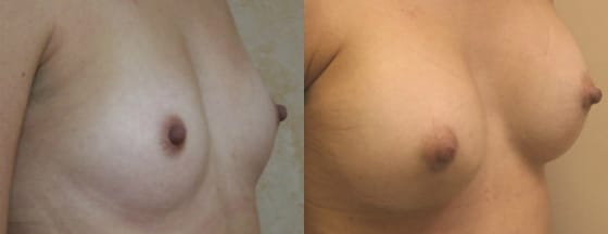 Breast Augmentation Before & After - Dr. Thomassen