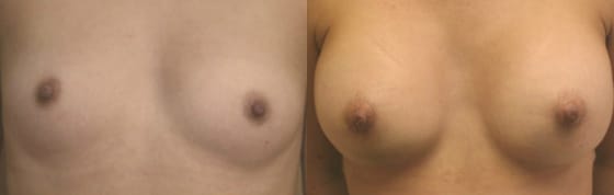 Breast Augmentation Before & After - Dr. Thomassen