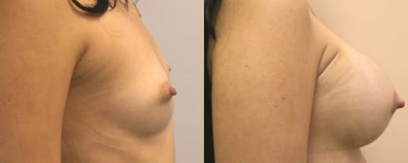 Breast Augmentation Before & After - Dr. Thomassen