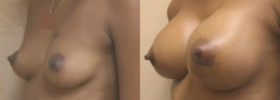 Breast Augmentation Before & After - Dr. Thomassen