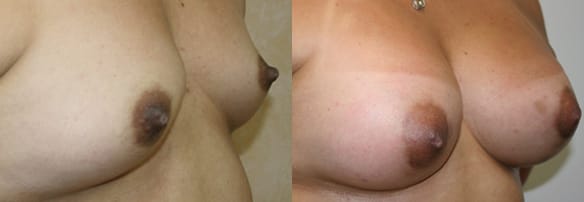 Breast Augmentation Before & After - Dr. Thomassen