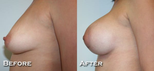 Breast Augmentation Before & After - Dr. Thomassen