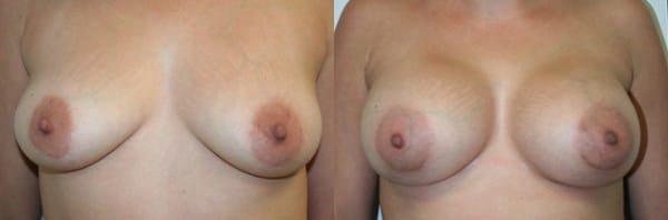 Breast Augmentation Before & After - Dr. Thomassen