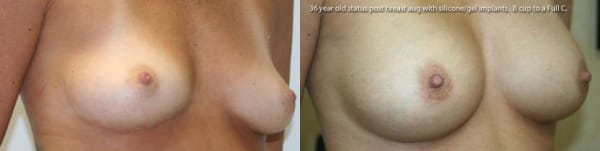 Breast Augmentation Before & After - Dr. Thomassen