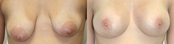 Breast Augmentation Before & After - Dr. Thomassen