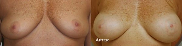 Breast Augmentation Before & After - Dr. Thomassen