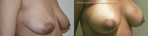 Breast Augmentation Before & After - Dr. Thomassen