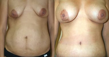 Breast Augmentation Before & After - Dr. Thomassen
