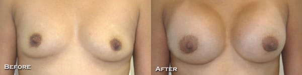 Breast Augmentation Before & After - Dr. Thomassen