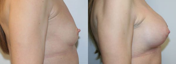 Breast Augmentation Before & After - Dr. Thomassen