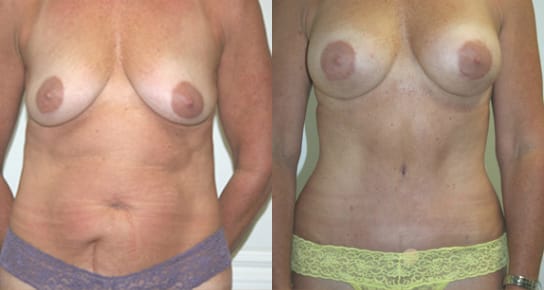 Breast Augmentation Before & After - Dr. Thomassen