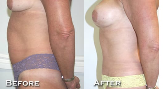Breast Augmentation Before & After - Dr. Thomassen