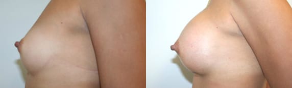 Breast Augmentation Before & After - Dr. Thomassen