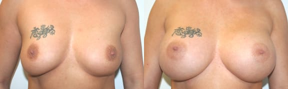 Breast Augmentation Before & After - Dr. Thomassen