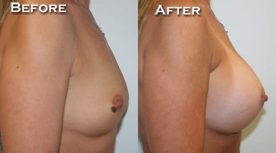 Breast Augmentation Before & After - Dr. Thomassen