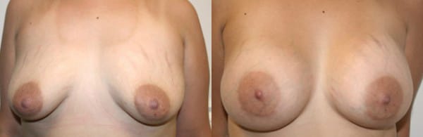 Breast Augmentation Before & After - Dr. Thomassen