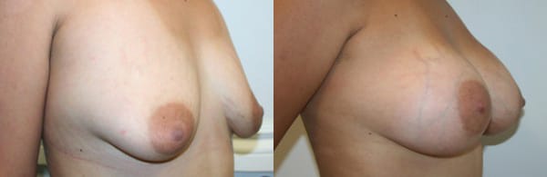 Breast Augmentation Before & After - Dr. Thomassen