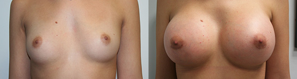Breast Augmentation Before & After - Dr. Thomassen