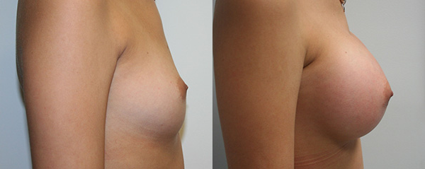 Breast Augmentation Before & After - Dr. Thomassen