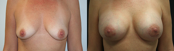 Breast Augmentation Before & After - Dr. Thomassen