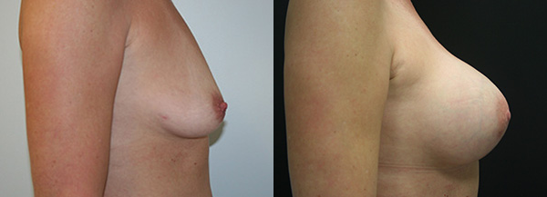 Breast Augmentation Before & After - Dr. Thomassen