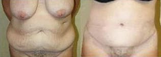 Body Contouring Before & After - Dr. Thomassen
