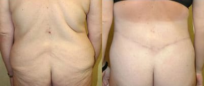 Body Contouring Before & After - Dr. Thomassen