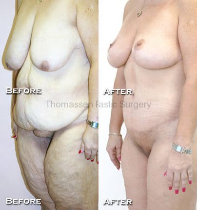 Body Contouring Before & After - Dr. Thomassen