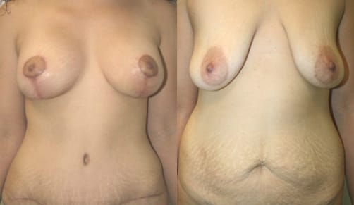 Breast Lift Before & After - Dr. Thomassen