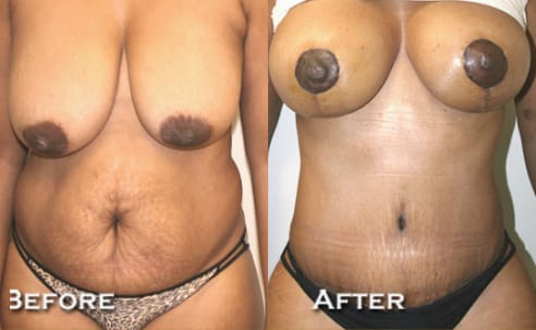 Breast Lift Before & After - Dr. Thomassen