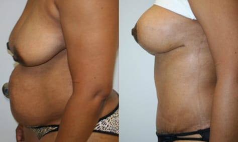 Breast Lift Before & After - Dr. Thomassen