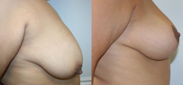 Breast Lift Before & After - Dr. Thomassen